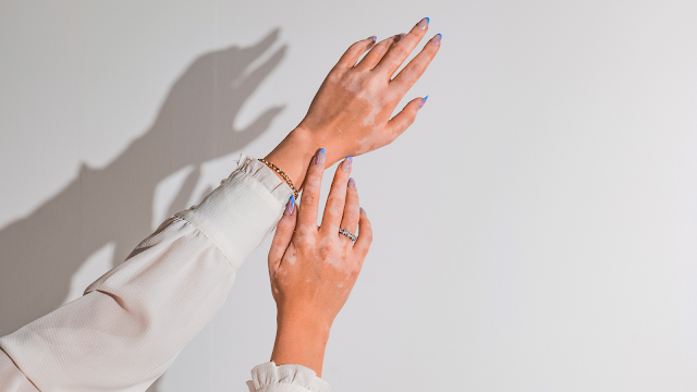 Vitiligo: o que é, tratamentos e curiosidades